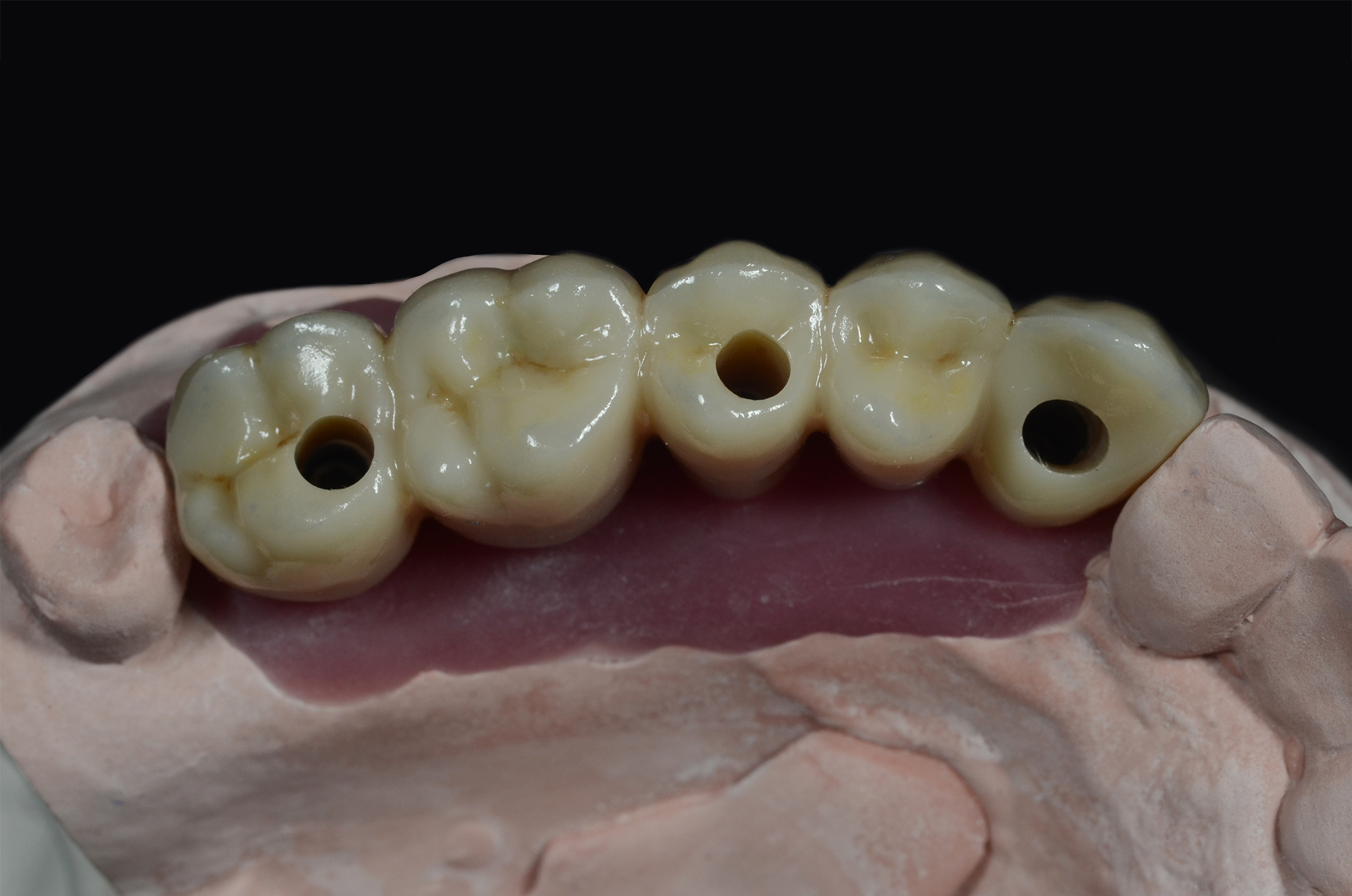 Zirconia Implant Bridge with Layering on Ti-Base